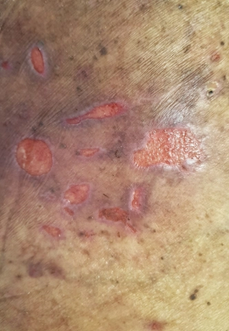 Pressure Ulcers (Bed Sores)